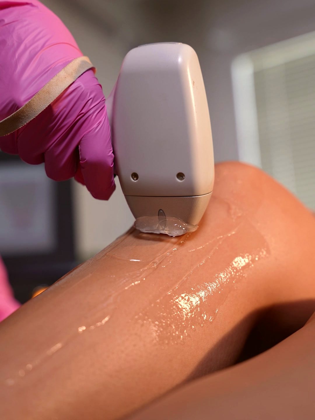 Soprano lazer epilasyon — SİS Nails Studio